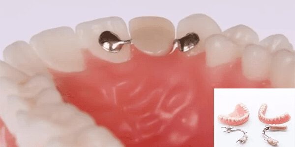 کاشت دندان بدون ایمپلنت