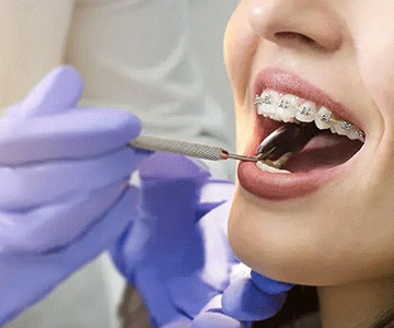 ارتودنسی بدون کشیدن دندان ها