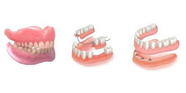 انواع پروتز دندان