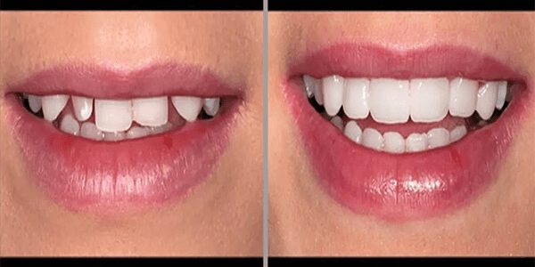 کامپوزیت یک روش درمانی بدون آسیب دیدن دندان‌های اصلی صورت می‌گیرد.