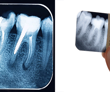 رادیوگرافی تک دندان