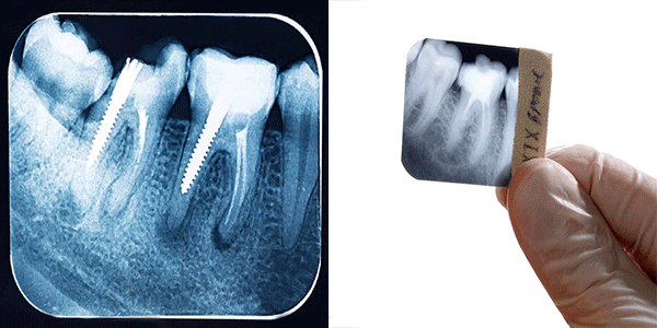 رادیوگرافی تک دندان