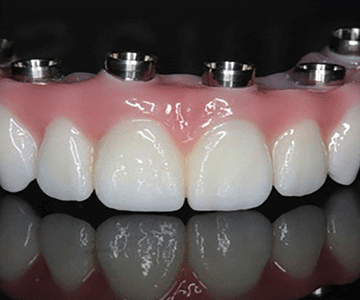 پروتزثابت دندان