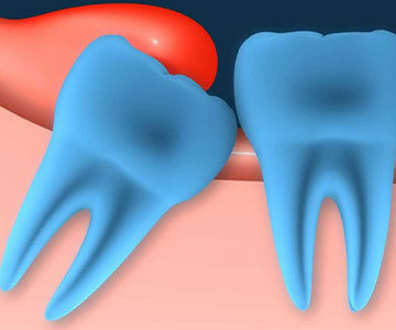 مراقبت های بعد از کشیدن دندان عقل