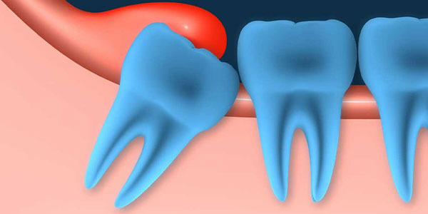 مراقبت های بعد از کشیدن دندان عقل