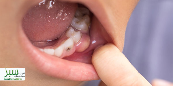 آبسه دندان اطفال