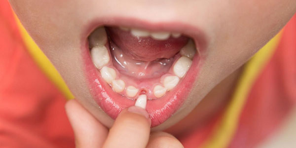 ترمیم دندان شکسته در کودکان