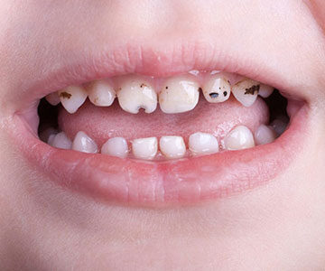 علائم پوسیدگی دندان کودکان
