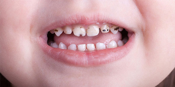 علائم پوسیدگی دندان کودکان