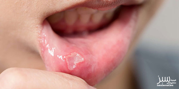 درمان خانگی آفت دهان کودک