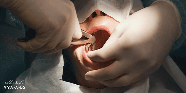 عفونت بعد از کشیدن دندان عقل