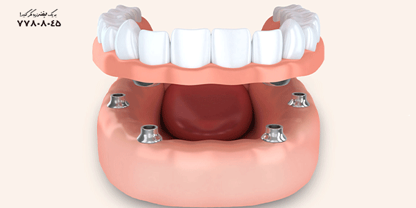 تفاوت دندان مصنوعی ثابت و متحرک - اوردنچر و دندان مصنوعی ثابت