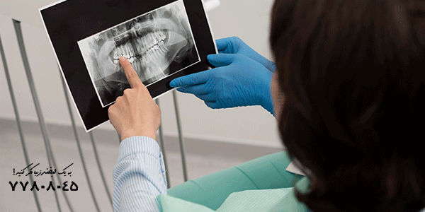ایمپلنت دندان در بارداری