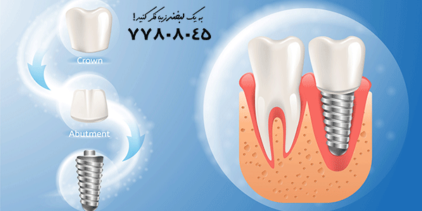 مراحل ایمپلنت دندان جلو