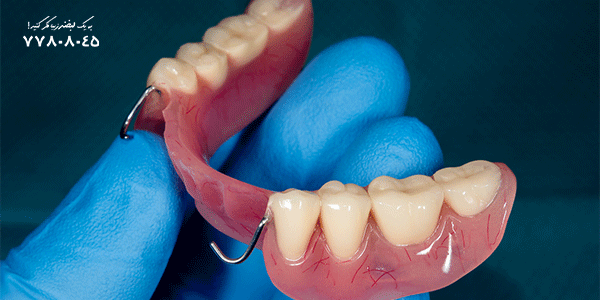 دندان مصنوعی ثابت یا متحرک