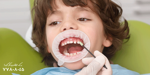 نحوه زدن فلوراید به دندان کودکان