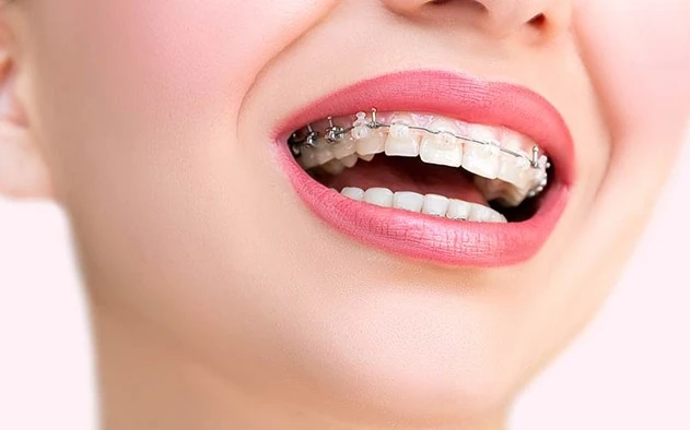 ارتباط ارتودنسی و دندان عقل