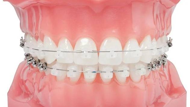 ارتودنسی بدون کشیدن دندان عقل