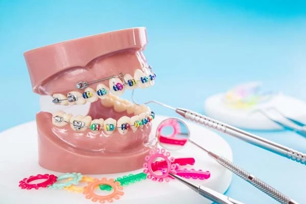 خدمات کشیدن دندان عقل برای ارتودنسی
