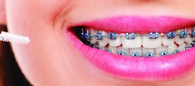 مدت زمان لازم برای ارتودنسی دندان
