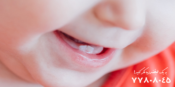 علت در نیامدن دندان دائمی کودکان