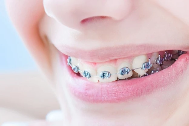 لق شدن دندان بعد از ارتودنسی - زیبایی دندان