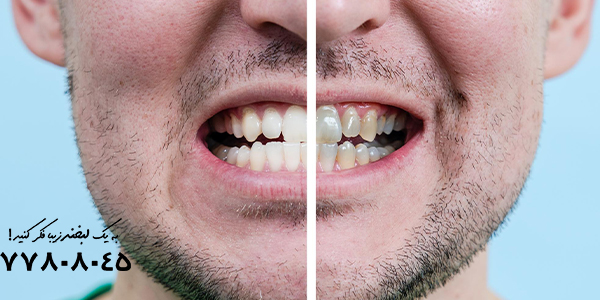 بلیچینگ دندان چقدر دوام دارد؟