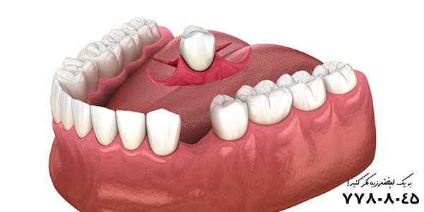 از بین بردن فاصله بین دندان‌ ها