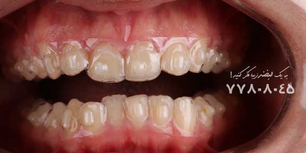 فاصله بین دندان ها بعد از ارتودنسی