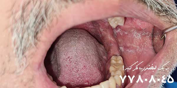 درمان زخم کنار زبان