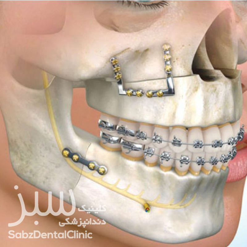 ارتودنسی به همراه جراحی فک