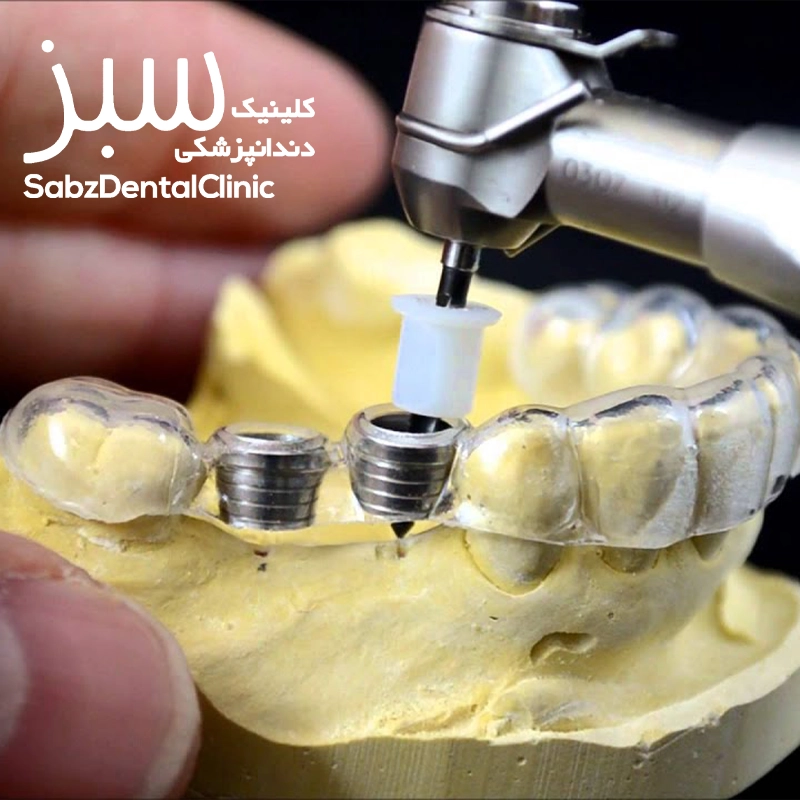 ایمپلنت دندان به روش دیجیتال