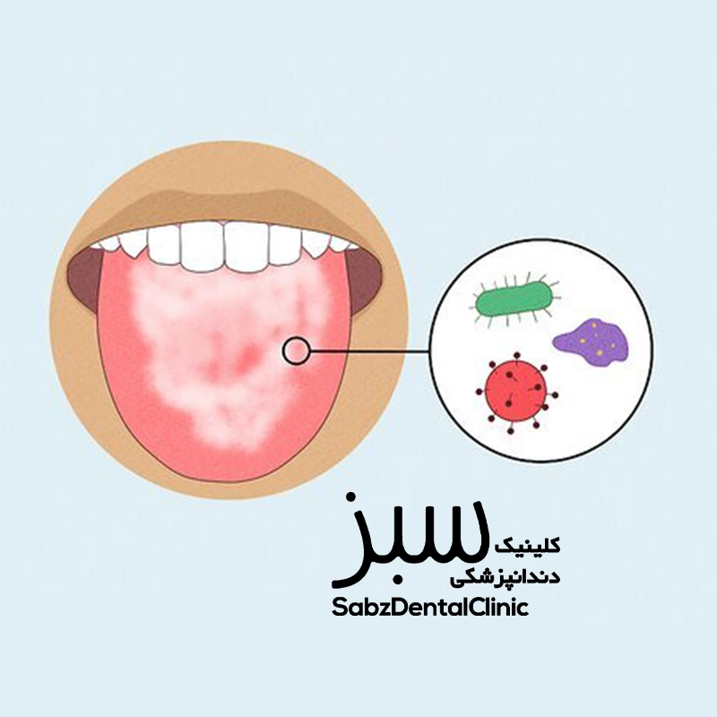 علت سفیدی زبان در طب سنتی